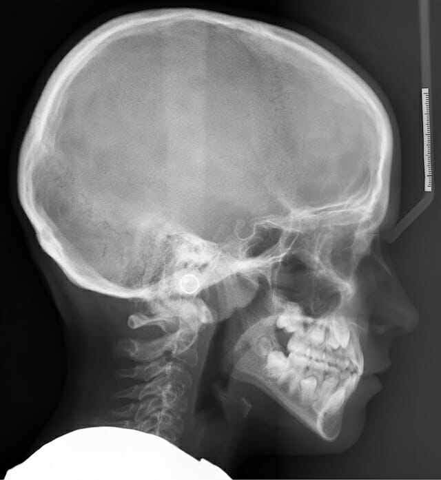 teleradiografia-del-cranio
