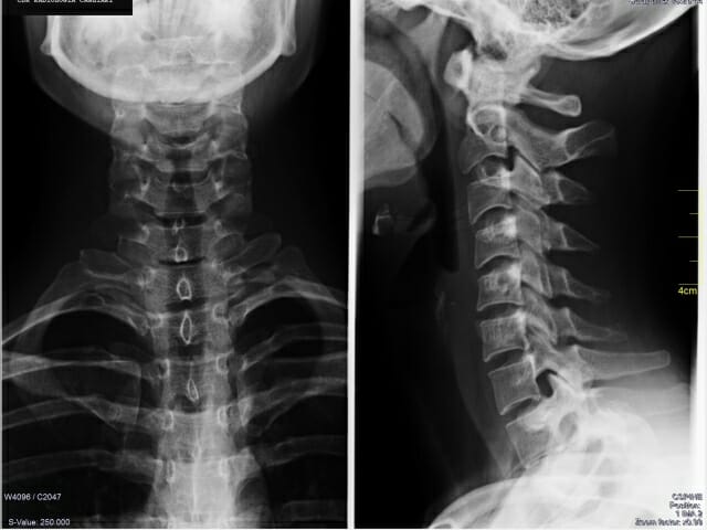 rx-colonna-cervicale